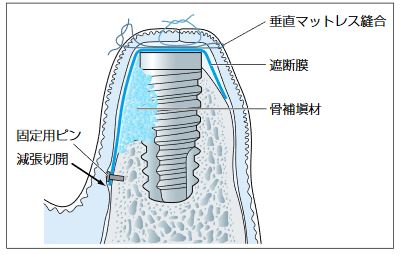 GBR法(骨組織誘導再生法)