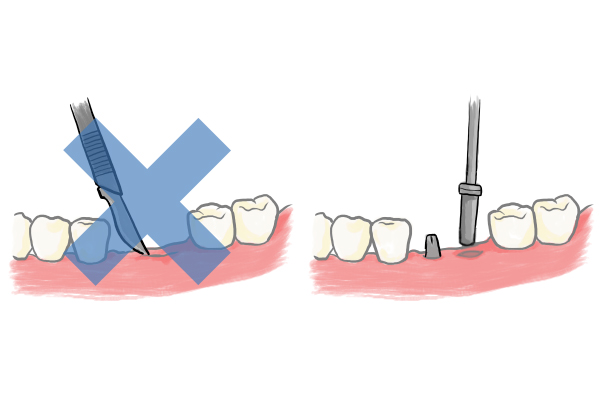 フラップレス手術