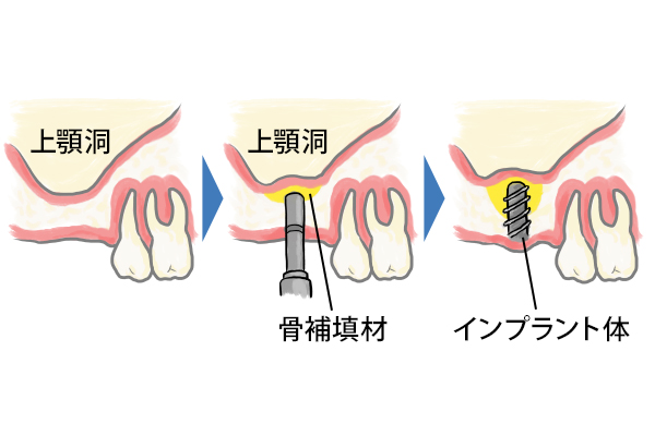 ソケットリフト