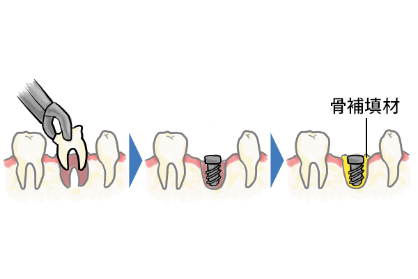 抜歯即時埋入・荷重インプラント